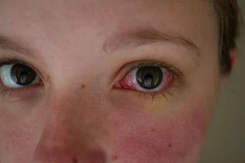 Những điều nên và không nên khi sơ cứu bệnh nhân bị trầy xước giác mạc